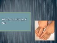 How to Treat Fungal Nail