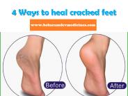4 ways to heal cracked feet