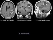 7.1a. Contrast axial T1 Wtd MRI