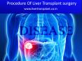 Dr Naimish mehta - Procedure of Liver Transplant surgery PowerPoint PPT Presentation