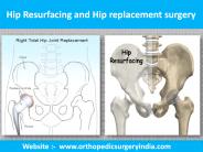 Hip resurfacing surgery in Delhi