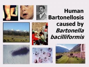Human Bartonellosis caused by Bartonella bacilliformis