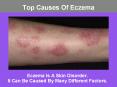 Top Causes Of Eczema PowerPoint PPT Presentation