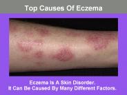 Top Causes Of Eczema