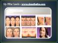 Lip Filler Leeds - www.claesthetics.com PowerPoint PPT Presentation