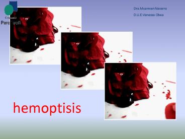 La hemoptisis consiste en la expulsi
