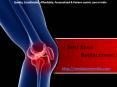 Best knee replacement PowerPoint PPT Presentation