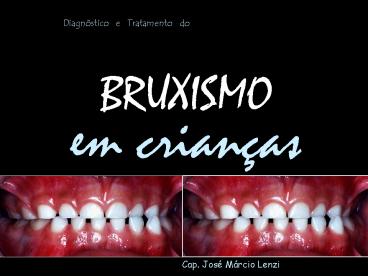BRUXISMO