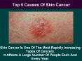 Top 5 Causes Of Skin Cancer PowerPoint PPT Presentation