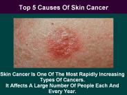 Top 5 Causes Of Skin Cancer