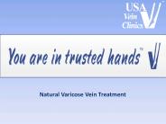 Natural Varicose Vein Treatment