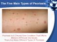 The Five Main Types of Psoriasis PowerPoint PPT Presentation