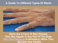 A Guide To Different Types Of Warts PowerPoint PPT Presentation