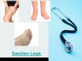 Swollen Legs PowerPoint PPT Presentation