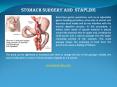 Doss India - Stomach Surgeon, Stomach Stapling Specialist in Pune PowerPoint PPT Presentation