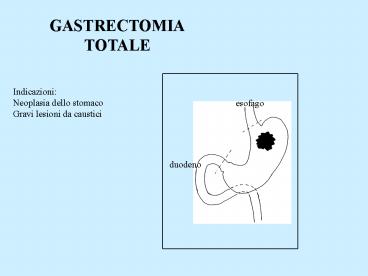 GASTRECTOMIA