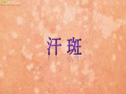 ??(Tinea versicolor) ?????????,??????????????,????????????,??????????????????,????????????,??????????,?????????????????????,??????????????????????,?????????????????? ???????? ?