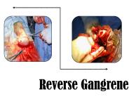 Natural Foot Gangrene Treatment
