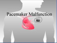 Pacemaker Malfunction