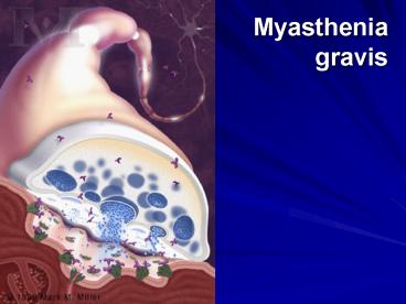 Myasthenia gravis