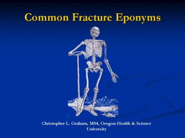 Common Fracture Eponyms