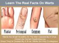 Learn The Real Facts On Warts PowerPoint PPT Presentation