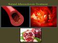 Natural Atherosclerosis Treatment PowerPoint PPT Presentation