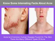 Know Some Interesting Facts About Acne