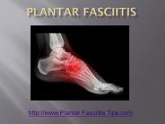 Plantar Fasciitis