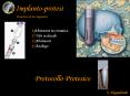 Implanto-protesi PowerPoint PPT Presentation