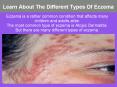 Learn About The Different Types Of Eczema PowerPoint PPT Presentation