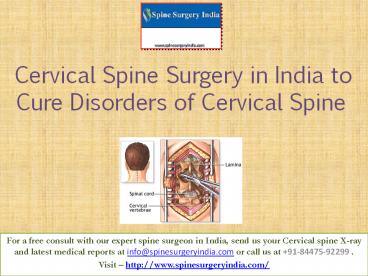 Cervical Spine Surgery in India