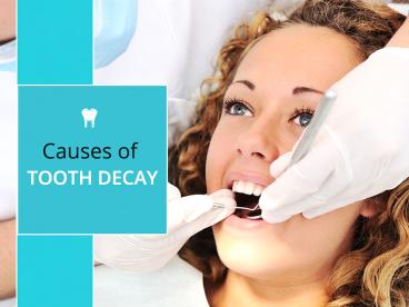 Causes of Tooth Decay – By Dentists in Bozeman, MT