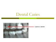 Dental Caries
