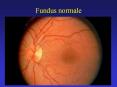 Fundus normale PowerPoint PPT Presentation
