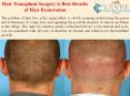 Hair Transplant Surgery is Best Results of Hair Restoration PowerPoint PPT Presentation