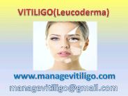vitiligo treatment