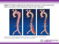 Mossop PJ et al. (2005) Staged endovascular treatment for complicated type B aortic dissection PowerPoint PPT Presentation