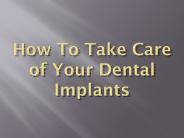How To Take Care of Your Dental Implants