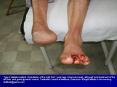 Type 2 diabetic patient. Amputation of the right foot 1 year ago; Ulcers are seen, although local treatment of the left foot with good glycemic control. Treatment: insulin at bedtime, Diamicron 30mg/4 tablets in the morning. PowerPoint PPT Presentation