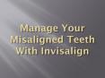 Manage Your Misaligned Teeth With Invisalign PowerPoint PPT Presentation