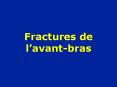 Fractures de l PowerPoint PPT Presentation