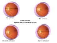 Fundus%20extorsion