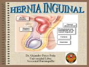 Hernias de la regi