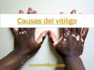 Causas del vitiligo