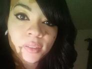 Síntomas del vitiligo