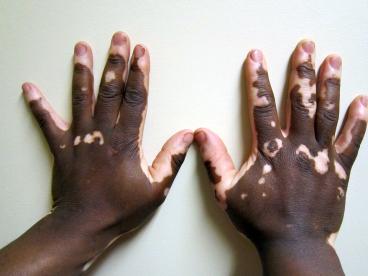 Vitiligo en niños