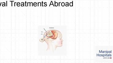 Brain Tumor Removal Treatments Abroad
