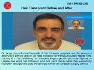 Hair Transplant Clinic in British Columbia