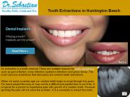 Tooth Extractions in Huntington Beach